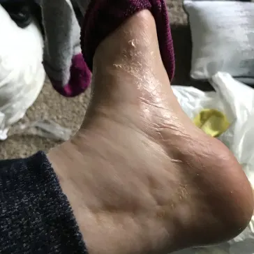 Cankles from carrying an extra 20 kg of fluid around.